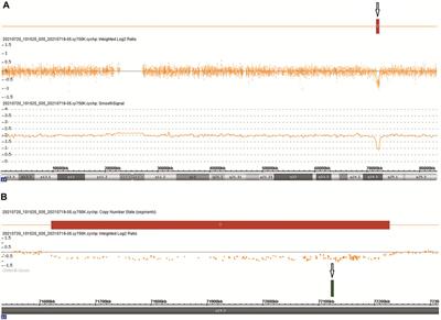 Case report: Cystic hygroma accompanied with campomelic dysplasia in the first trimester caused by haploinsufficiency with SOX9 deletion